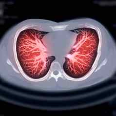 胸部轴向米兰理工大学管理学院视图诊断肺癌症肺结核科维德
