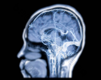 MRV大脑磁共振静脉造影术大脑异常静脉排水大脑矢状面视图