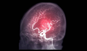 脑血管<strong>造影</strong>术斜横向视图图像透视干预放射学显示脑<strong>动脉</strong>