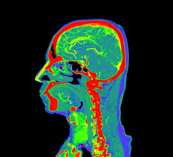 色彩斑斓的血管<strong>造影</strong>术大脑进行合作。大脑矢状面视图剪裁路径