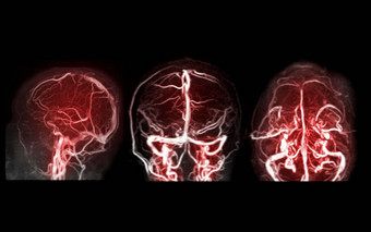 MRV大脑磁共振静脉造影术大脑异常静脉排水大脑