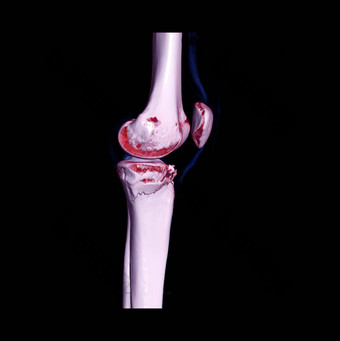 膝盖联合呈现图像显示骨折胫骨骨