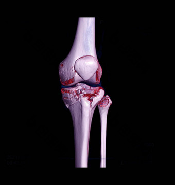 <strong>膝盖</strong>联合呈现图像显示骨折胫骨骨