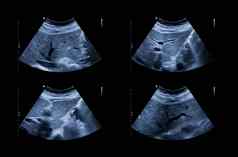 超声波上腹部显示肝瘿膀胱筛选肝细胞癌胆石
