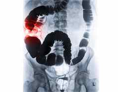 钡灌肠图像大肠注射钡对比填满结肠荧光镜的控制