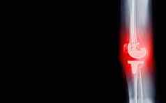 电影x射线横向视图骨关节炎膝盖病人人工联合膝盖更换