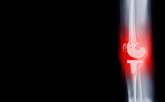 电影x射线横向视图<strong>骨关节</strong>炎膝盖病人人工联合膝盖更换