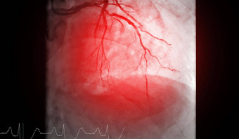 心脏导管插入术测试找到心脏逮捕