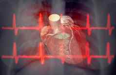 胸部x射线心电图呈现图像诊断船冠状动脉动脉狭窄
