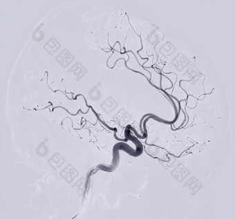 脑血管造影术横向视图图像透视干预放射学显示脑动脉
