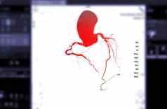 进行合作。冠状动脉动脉呈现图像屏幕诊断船冠状动脉动脉狭窄