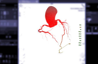 进行合作。冠状动脉动脉呈现图像屏幕诊断船冠状动脉动脉狭窄
