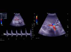 超声波上腹部显示流常见的甚至管颜色多普勒