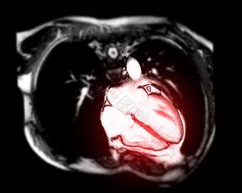 核磁共振心心脏核磁共振磁共振成像心垂直轴视图显示室心诊断心疾病