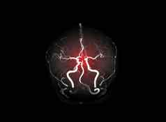 集合mra大脑磁共振血管造影术图像
