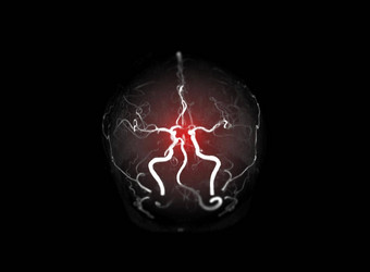 集合mra大脑磁共振血管造影术图像