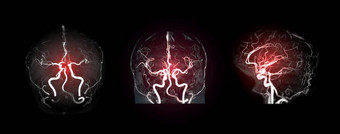 集合mra大脑磁共振血管造影术图像mra脑动脉大脑检测中风疾病