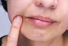 角唇炎类型常见的炎症嘴唇