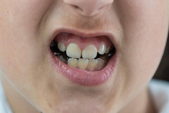 成人永久牙齿未来前面孩子婴儿牙齿鲨鱼牙齿女孩的开放口咨询牙医问题