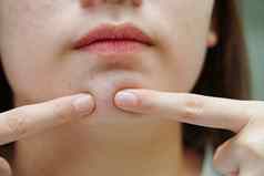 痤疮丘疹疤痕皮肤脸障碍皮脂腺十几岁的女孩护肤品美问题