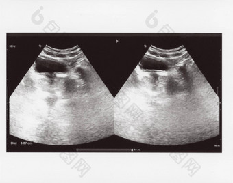 完整的腹部超声波sonogram