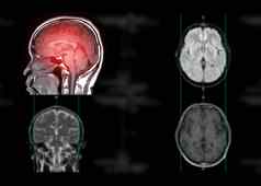 核磁共振大脑轴向飞机检测中风疾病大脑肿瘤囊肿