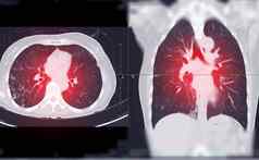 胸部扫描肺轴向矢状面视图