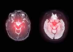 核磁共振大脑轴向扩散图像检测中风疾病大脑肿瘤囊肿