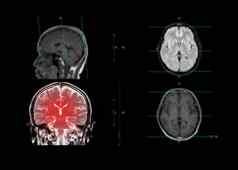 核磁共振大脑显示冠状飞机大脑