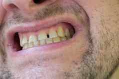 牙齿斑块龋齿男人。