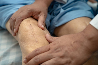亚洲高级上了年纪的夫人女人病人显示伤疤外科手术<strong>总计</strong>膝盖联合更换缝合伤口手术关节成形术床上护理医院病房健康的强大的医疗概念