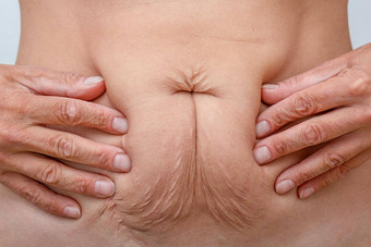 手肚子按下皮肤显示下垂皮肤饮食拉伸标志着怀孕