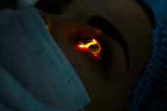 医疗激光眼睛修正医学技术眼睛操作