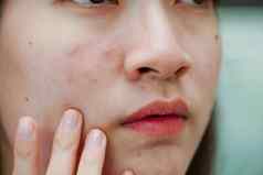 痤疮丘疹疤痕皮肤脸障碍皮脂腺十几岁的女孩护肤品美问题