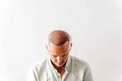 头发移植外科手术技术移动头发毛囊年轻的秃男人。绷带头发损失问题白色背景复制空间