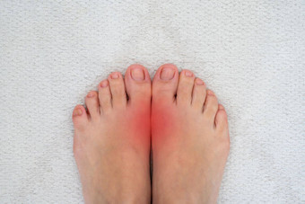 脚疾病风湿病痛风痛苦的痛风炎症大然后联合红色的点