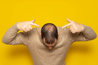 人类<strong>脱发</strong>头发损失中年拉丁美洲人男人。指出头高亮显示初期的<strong>脱发</strong>