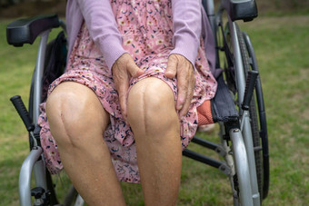 亚洲高级上了年纪的夫人女人病人显示伤疤外科手术总计膝盖联合<strong>更换</strong>缝合伤口手术关节成形术床上护理医院病房健康的强大的医疗概念