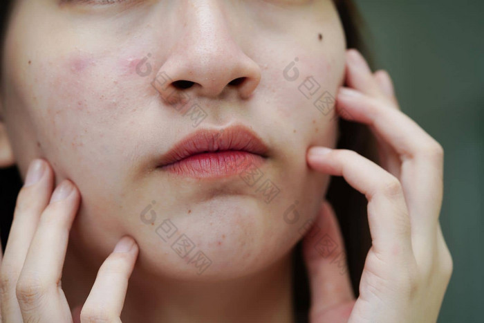 痤疮丘疹疤痕皮肤脸障碍皮脂腺十几岁的女孩护肤品美问题