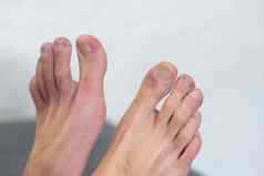 白色男人。持有脚趾显示皮疹红色的有疤的皮肤常见的一边效果科维德被称为科维德然后