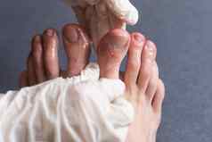 科维德脚趾冠状病毒症状肿胀变色紫色颜色疼痛粗糙的皮肤