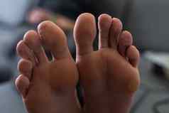 男人的脚趾显示皮疹红色的有疤的皮肤常见的一边效果科维德被称为科维德然后