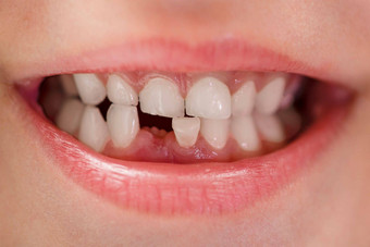 孩子们的微笑微笑孩子年牙<strong>特写</strong>镜头损失孩子们的牙齿牙科护理口服卫生孩子们