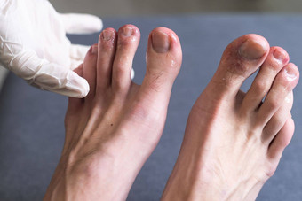 男人的脚趾显示皮疹红色的有疤的皮肤常见的一边效果科维德被称为科维德然后