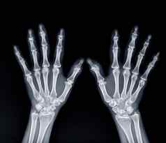 电影x射线手视图显示人的手孤立的黑色的背景