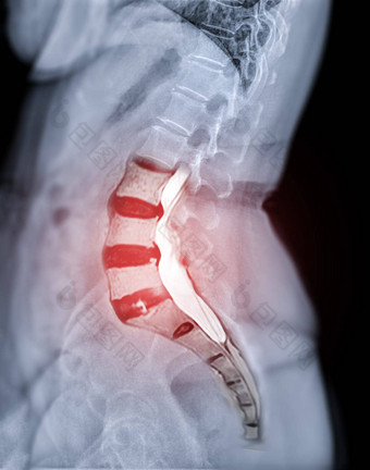 x射线图像腰椎脊柱自旋脊柱横向视图核磁共振自旋脊柱诊断较低的回来疼痛