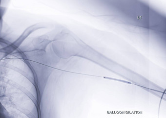 血管成形术气球血管成形术经皮穿血管成形术家长会左手臂