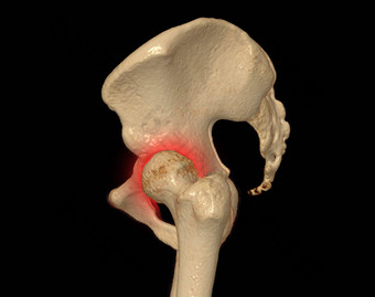 扫描<strong>骨盆</strong>骨臀部联合呈现诊断骨折<strong>骨盆</strong>骨臀部联合孤立的黑色的背景