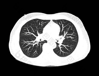 扫描胸部肺放射学部门医院科维德扫描身体x光测试检测科维德病毒疫情传播概念
