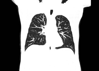 <strong>扫描</strong>胸部肺放射学部门医院科维德<strong>扫描</strong>身体x光测试检测科维德病毒疫情传播概念